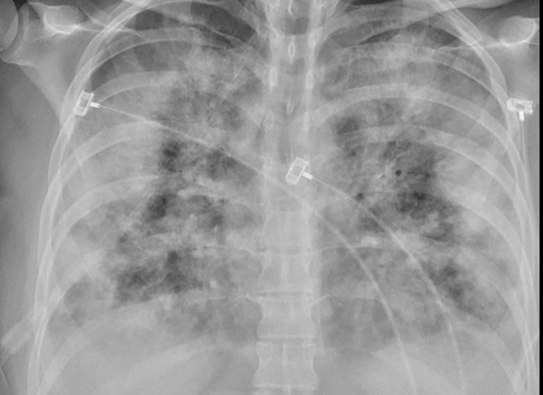 Weiße flecken lunge