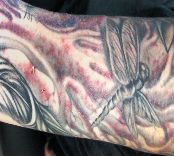 Tattoo Des Grauens Mit Der Libelle Kam Die Tuberkulose 20 Minuten Tattoo Des Grauens Mit Der Libelle Kam Die Tuberkulose 20 Minuten