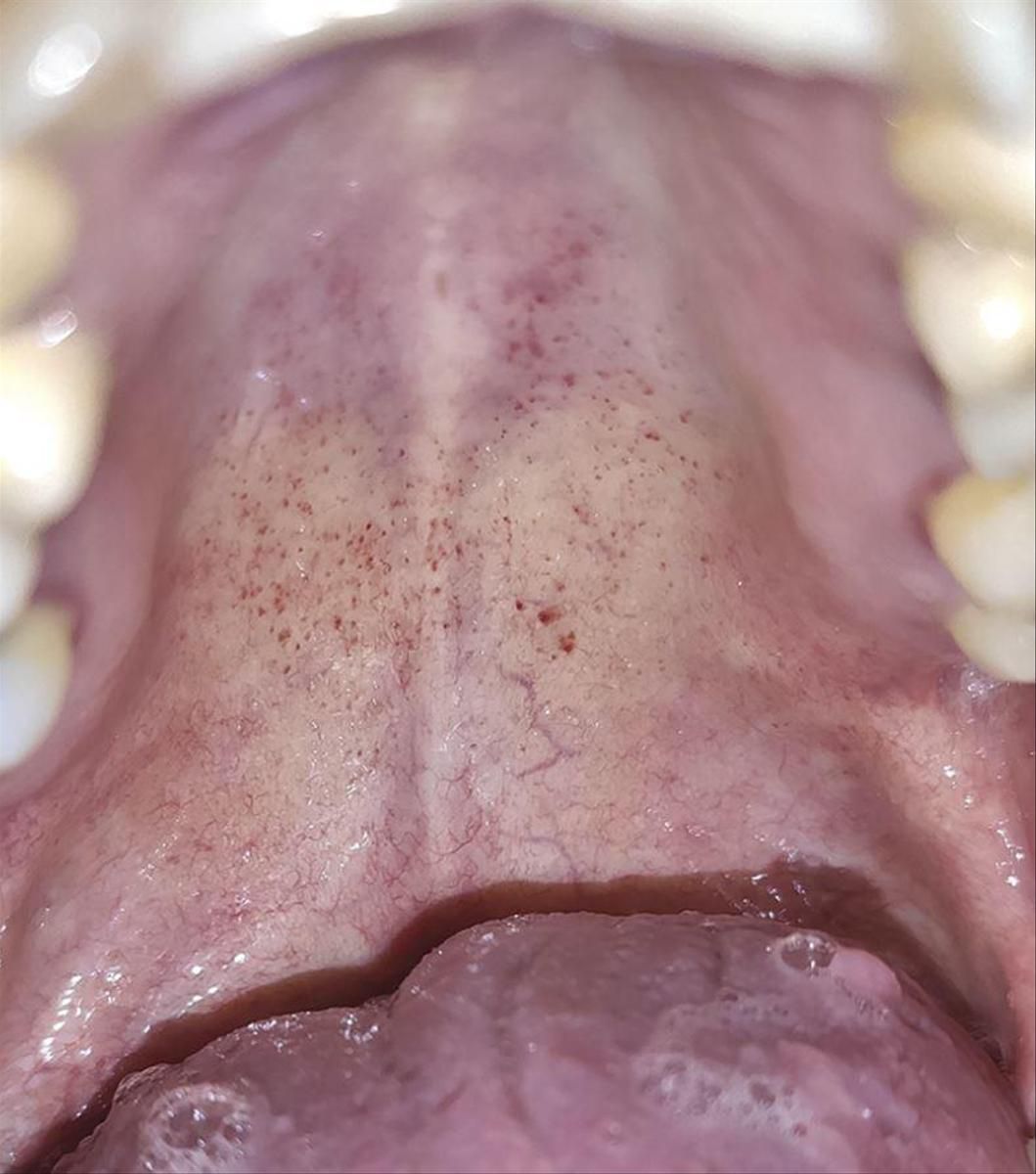 Coronavirus Des Chercheurs Decouvrent Un Nouveau Symptome Du Covid 19 Minutes