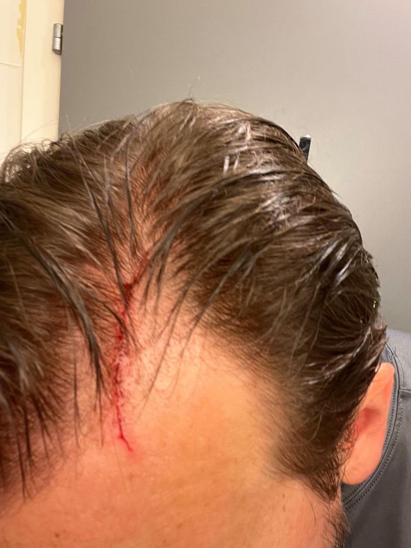 Peter Vanham s’est fait attaquer par une buse alors qu’il faisait son jogging. Les serres du rapace lui ont fait de grandes griffures à la tête.