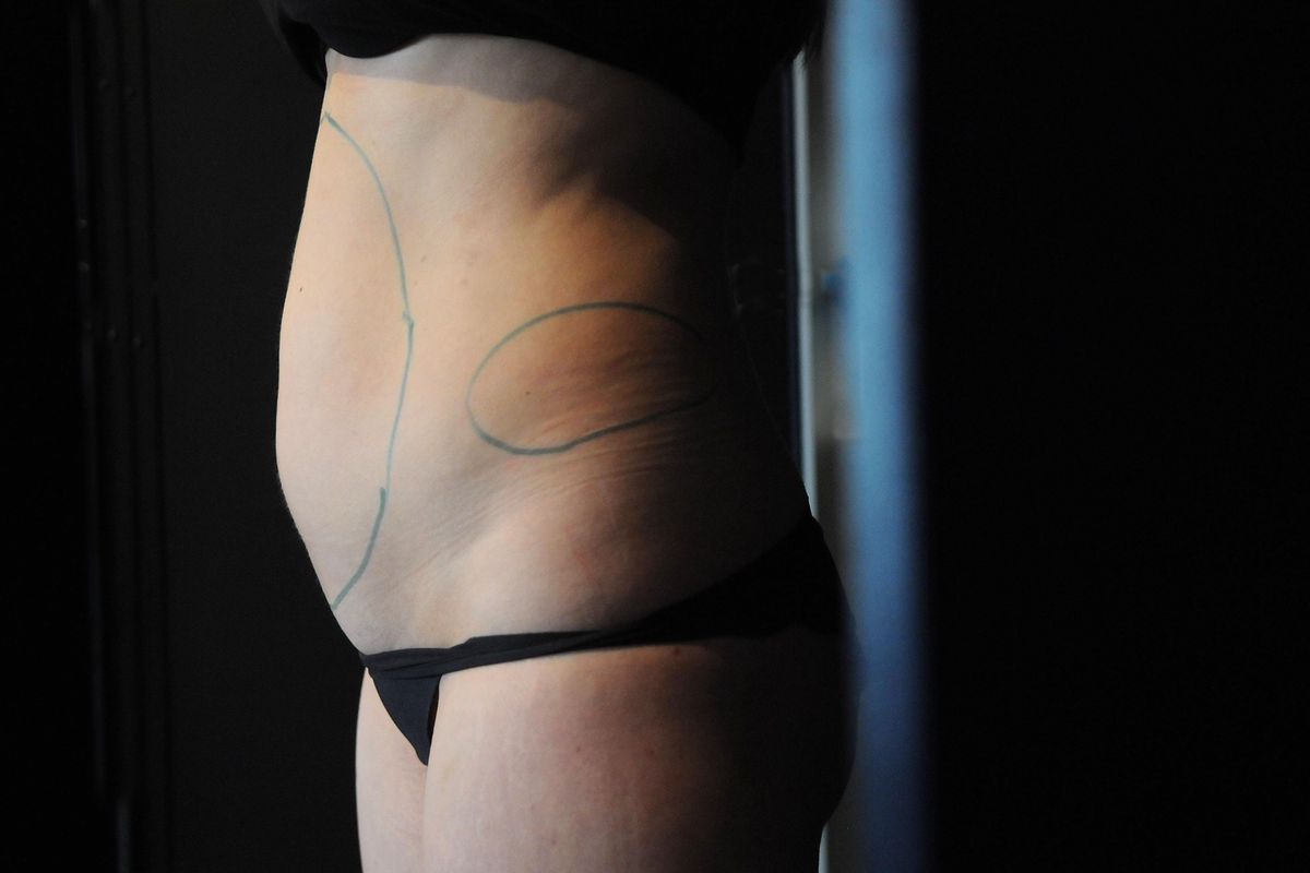 Vue latérale d’un ventre avec des lignes tracées, indiquant la zone à traiter pour une lipolyse à Lausanne.