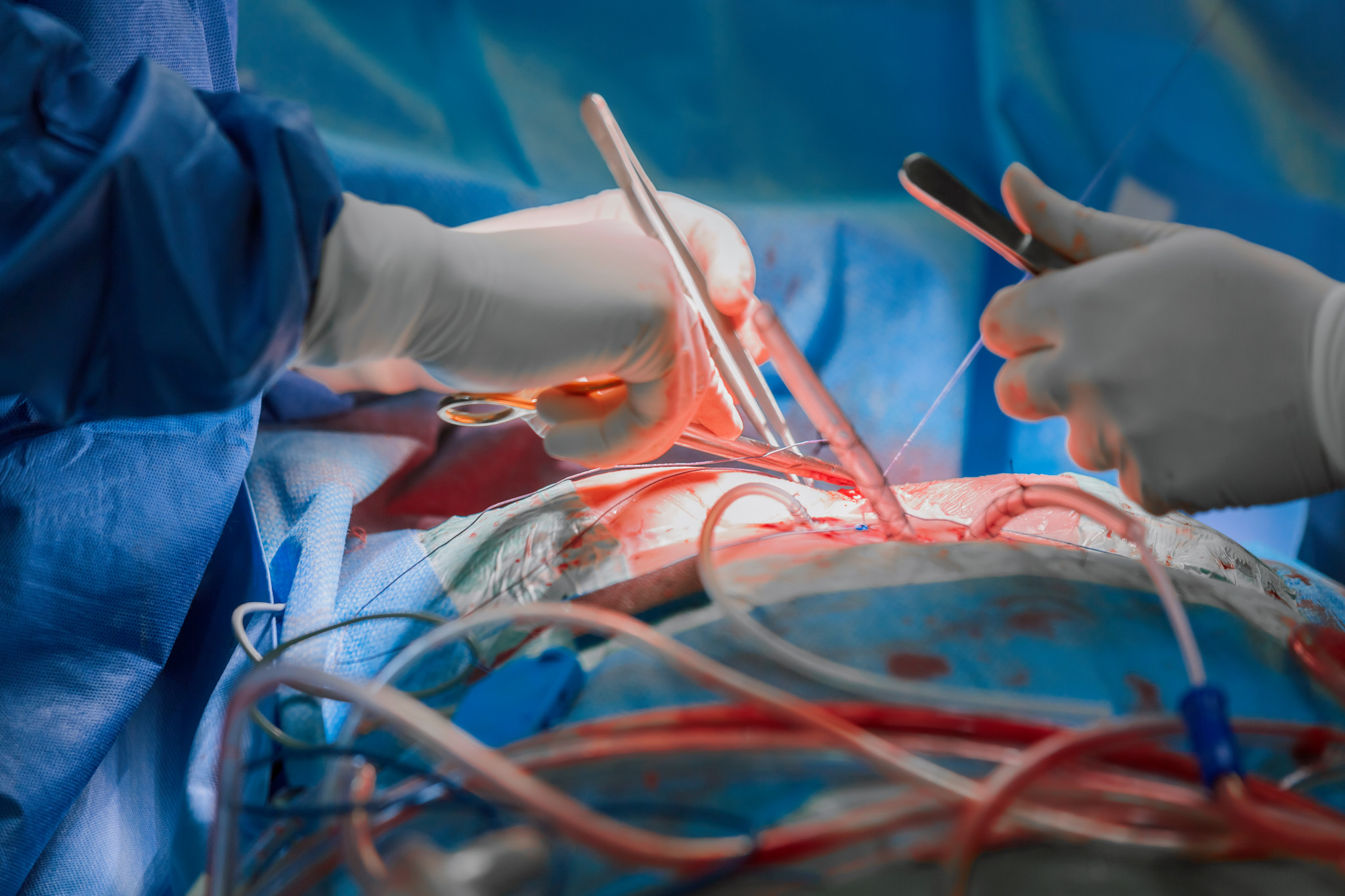 Chirurgiens opérant avec des instruments médicaux en gros plan, lumière focalisée sur la zone opérée.