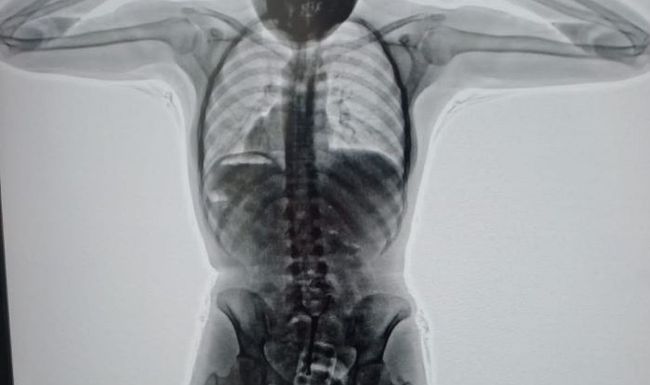 Im Körper einer Drogenschmugglerin entdeckten argentinische Behörden 78 Plastikkapseln voller Kokain.