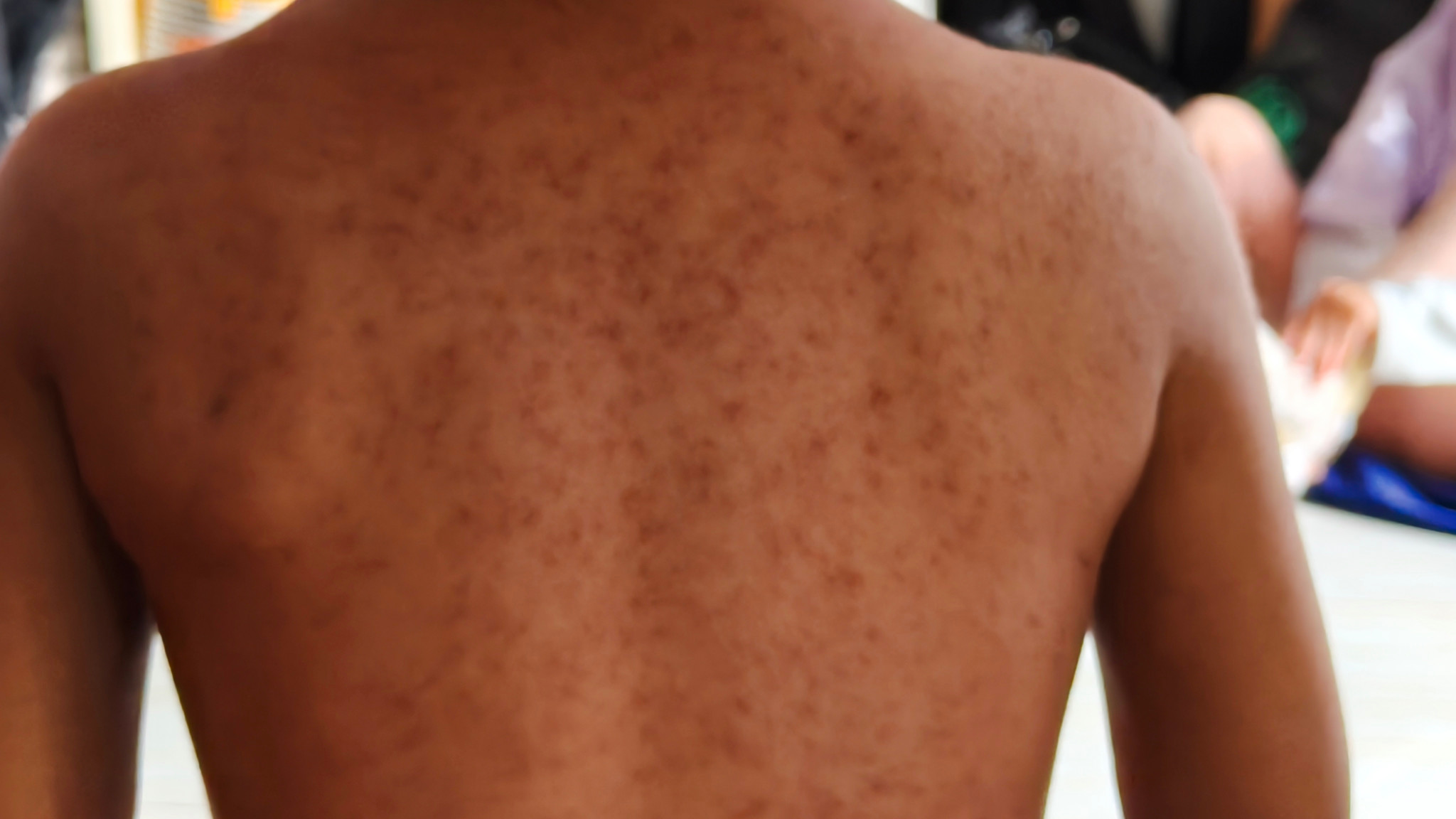 Low vaccination rates in the USA: Pennsylvania records the largest measles outbreak in 30 years