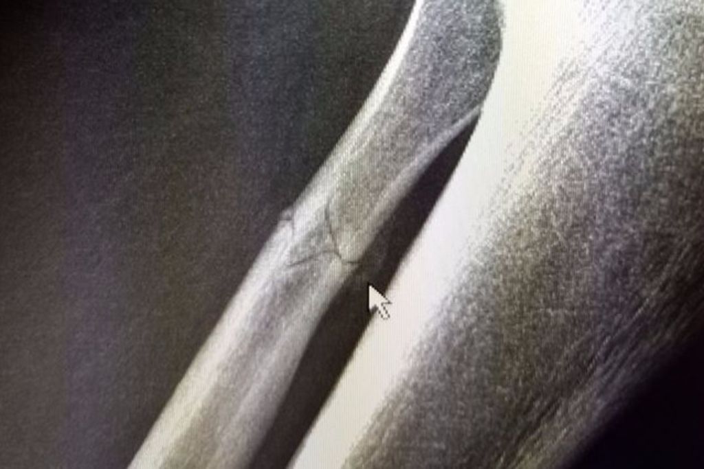 Il termine 2e à Kitzbühel avec un péroné fracturé