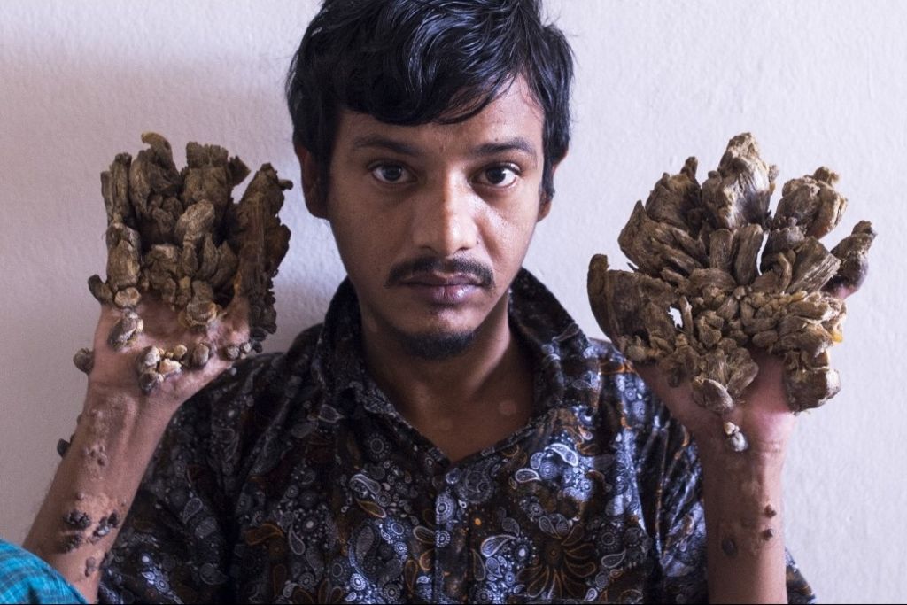 «L'homme-arbre» veut qu'on lui ampute les mains