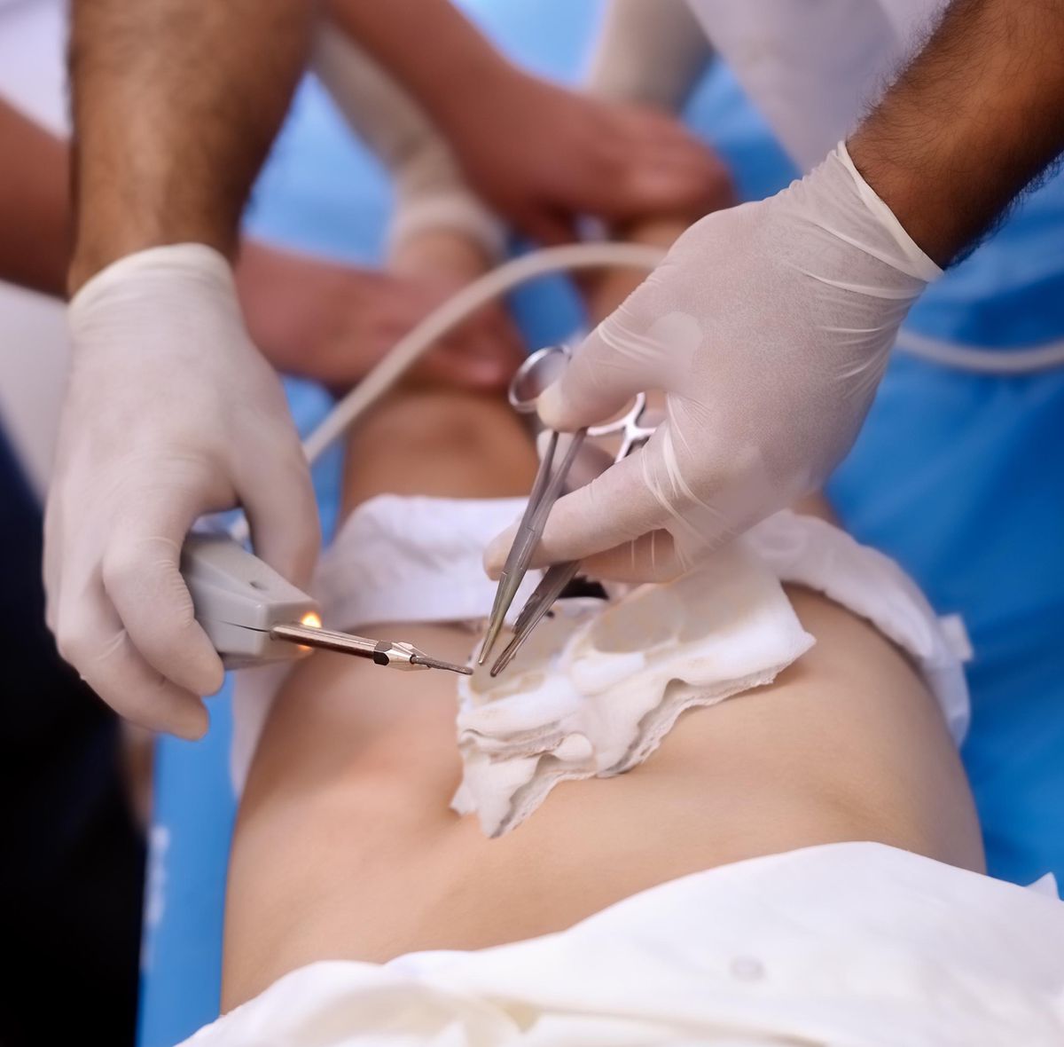 Image d’illustration. Opération de circoncision sur un enfant.