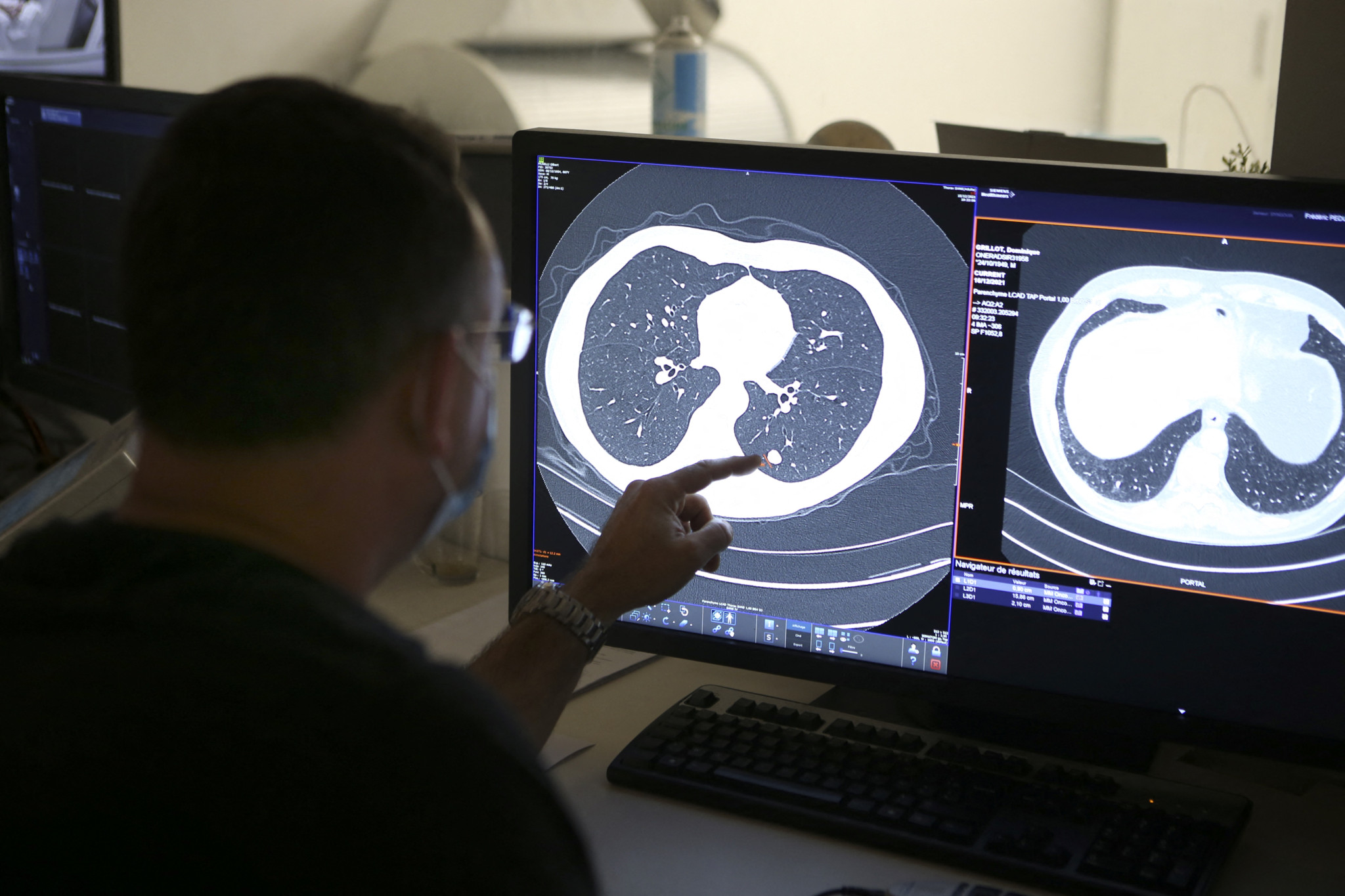 Cancer du poumon: Vaud lance un dépistage pour fumeurs