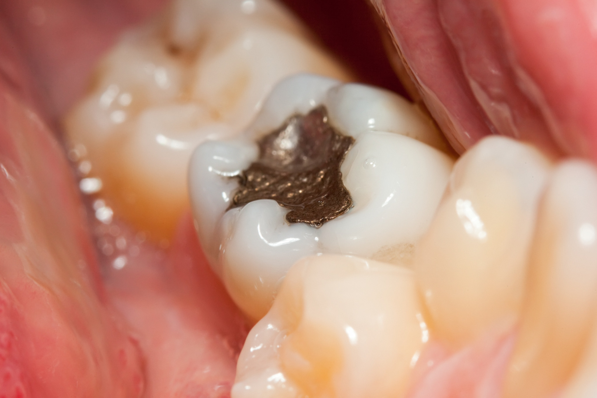 Zahnfllung: Soll das Amalgam aus Quecksilber raus?