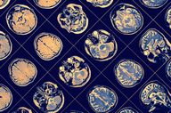 Studie: Newron kündigt neue Daten zum Schizophrenie-Hoffnungsträger an