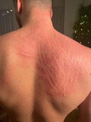 Apres Le Booster Demangeaisons Et Eruptions Cutanees Toujours Plus Frequentes Minutes