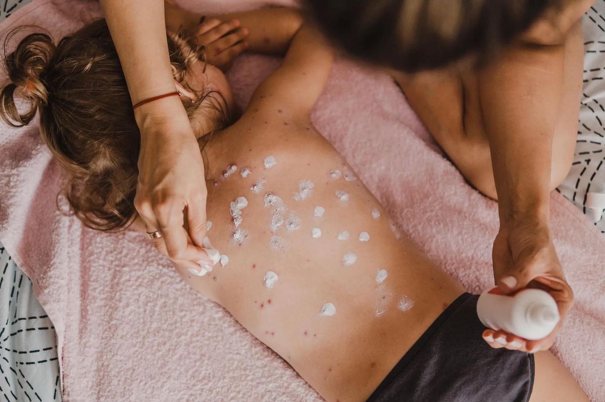 Enfant avec des boutons de varicelle