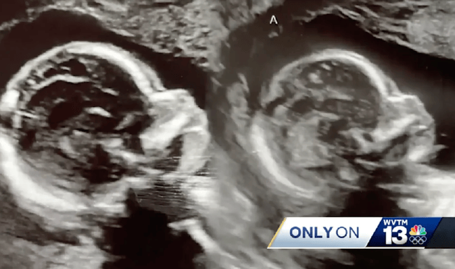 Diese Babys sind eine medizinische Sensation: Sie wachsen in zwei separaten Gebärmüttern heran. Die Wahrscheinlichkeit dafür liegt bei etwa eins zu einer Million.